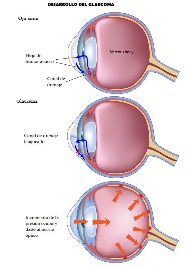 Definir medicamentos para la hipertensión ocular